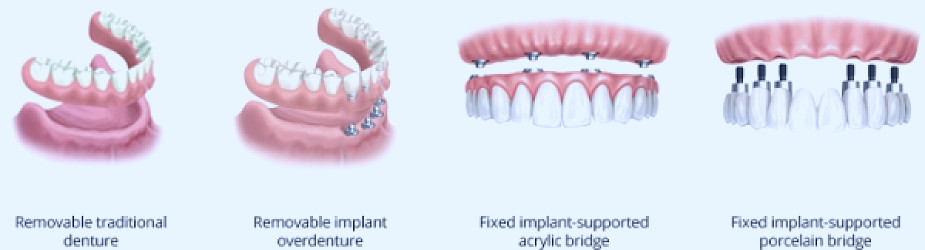How much are full mouth dental implants?